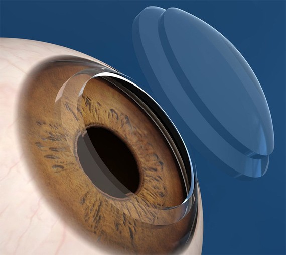 transplante-cornea_big