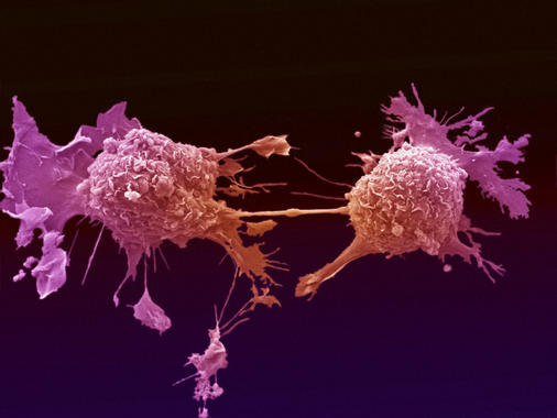 B0006883 Lung cancer cells